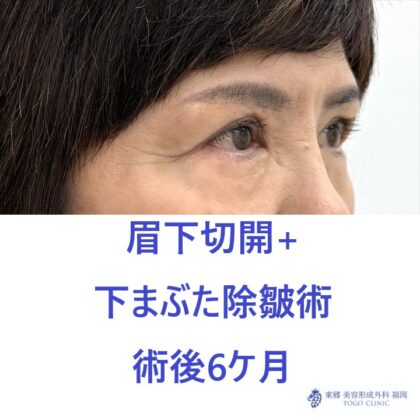 MT　上下たるみ６M後 (2)