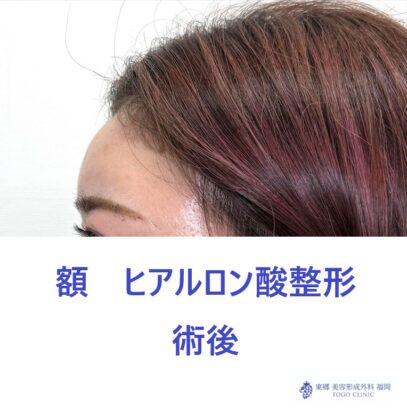 RH　額HA術後 (2)
