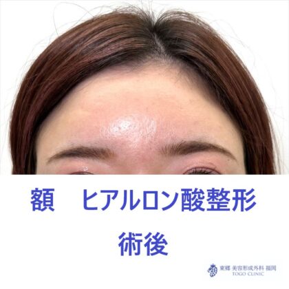 RH　額HA術後