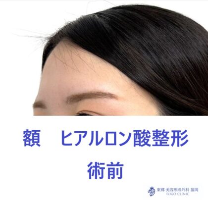 SK　額HA術前 (2)