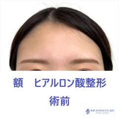 SK　額HA術前