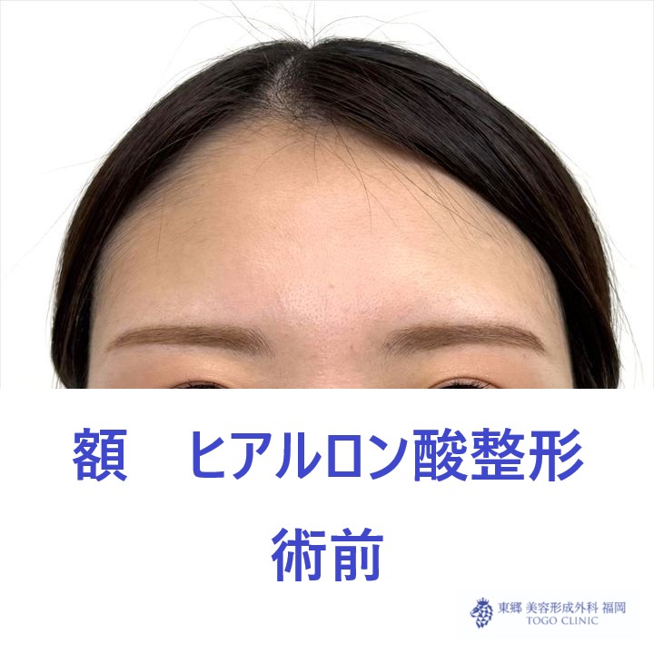 SK　額HA術前