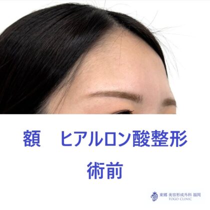 SK　額HA術前 (3)