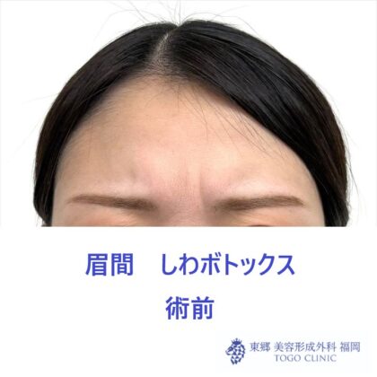 SK　眉間Btx術前