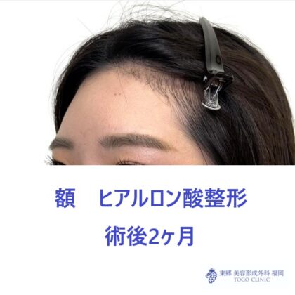 額HA術後 (3)_R