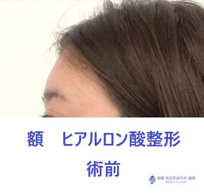 RH　額HA術前 (2)