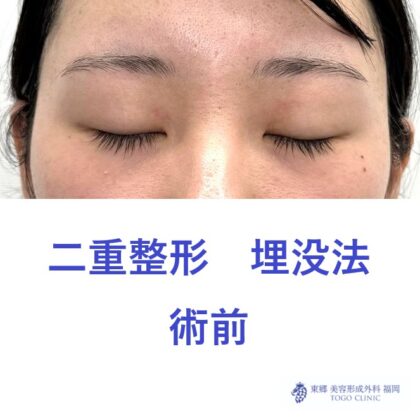 ヒダカナツキ術前 (2)