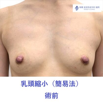SK　乳頭縮小術前