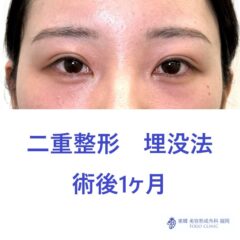 ﾋﾀﾞｶﾅﾂｷ術後