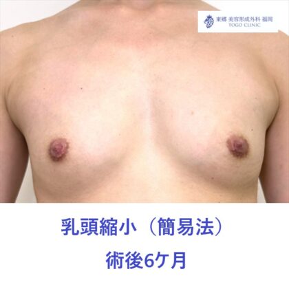 SK　乳頭縮小術後