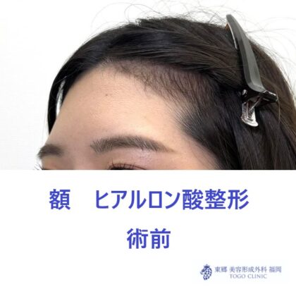 額HA術前 (3)_R