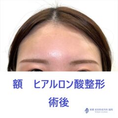 SK　額HA術後