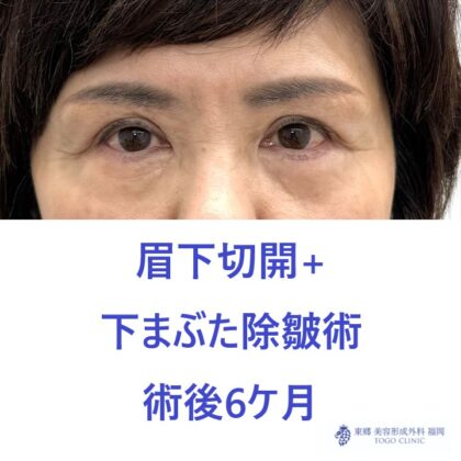 MT　上下たるみ６M後 (1)