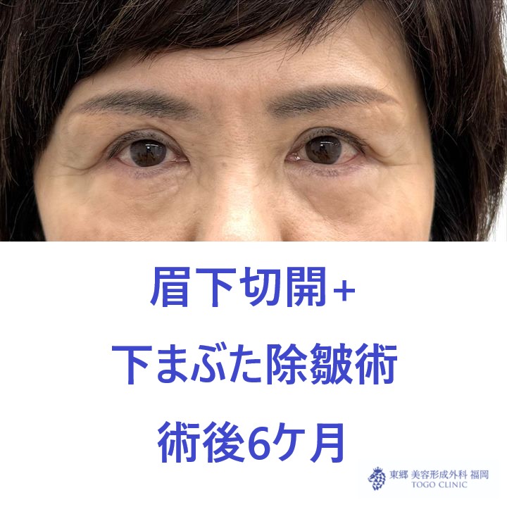 MT　上下たるみ６M後 (1)