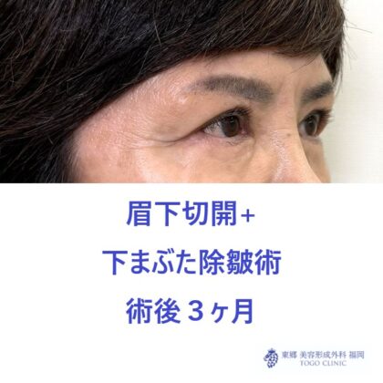 MT　眉下+下たるみ術後 (2)