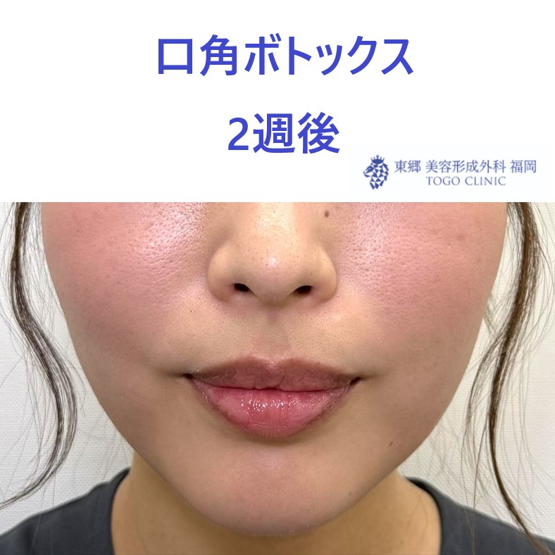 口角ボトックス