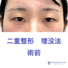 ﾋﾀﾞｶﾅﾂｷ術前