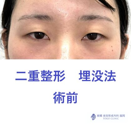 ヒダカナツキ術前