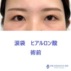 SK 涙袋術前