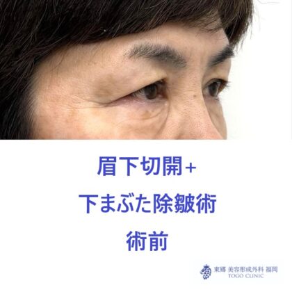 MT　眉下+下たるみ　術前