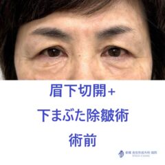 MT 眉下+下たるみ　術前