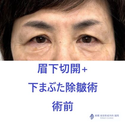 MT 眉下+下たるみ　術前