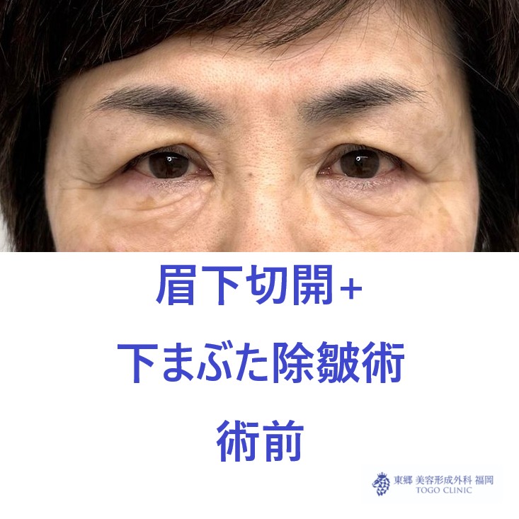 MT 眉下+下たるみ　術前