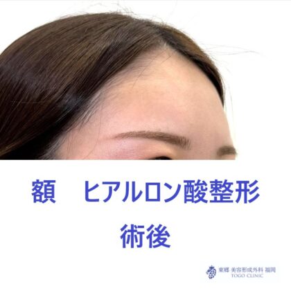 SK　額HA術後 (3)