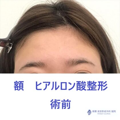 RH　額HA術前