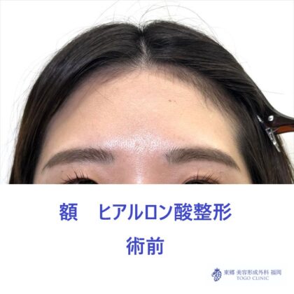額HA術前_R
