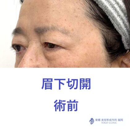 MS眉下術前 (2)