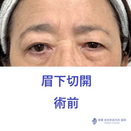 MS眉下術前