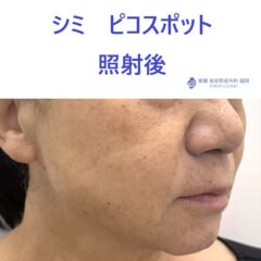 KM　シミスポット　術後