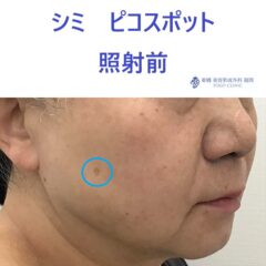 KM　シミスポット　術前