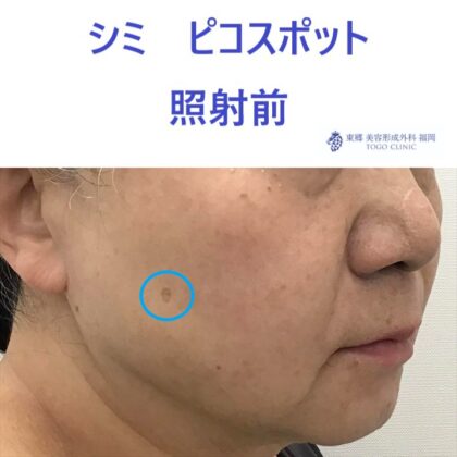 KM　シミスポット　術前