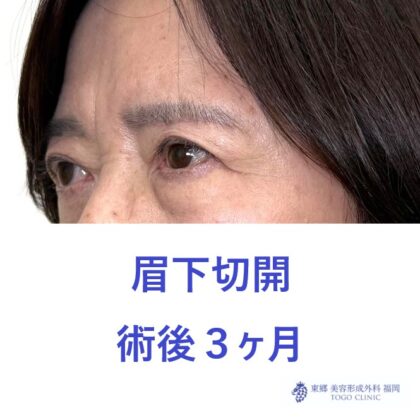 MS眉下術後 (2)