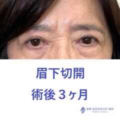 MS眉下術後