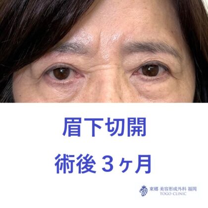 MS眉下術後