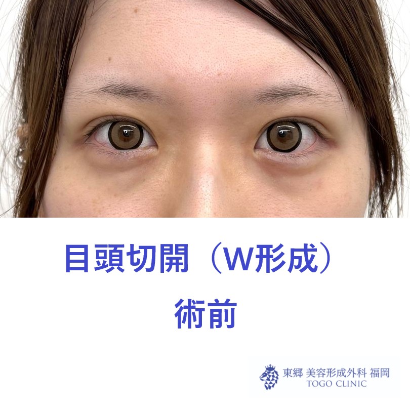 MK　目頭　術前_R