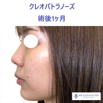 MS　KPノーズ術後 (2)