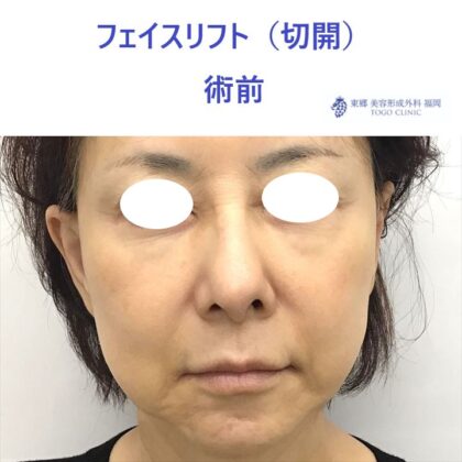 AU　フェイスリフト術前