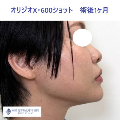 AK　オリジオ術後 (3)