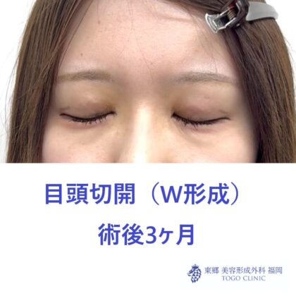 MK　目頭　術後 (2)_R