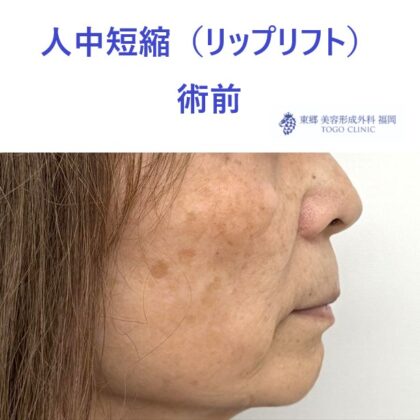 TT　ﾘｯﾌﾟﾘﾌﾄ術前 (2)