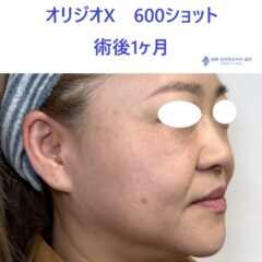 YS オリジオ術後 (2)