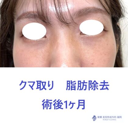 HN　経結膜術後1M