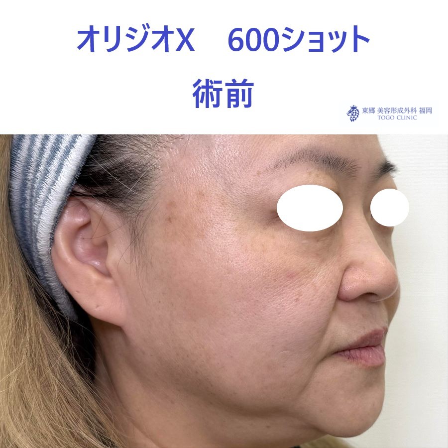 YS　オリジオ術前