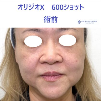 YS オリジオ術前