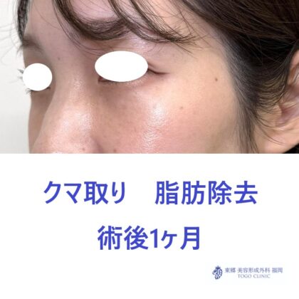 HN　経結膜術後1M (3)