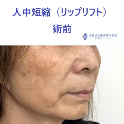 TT　ﾘｯﾌﾟﾘﾌﾄ術前